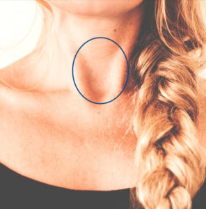 thyroid and homeopathy